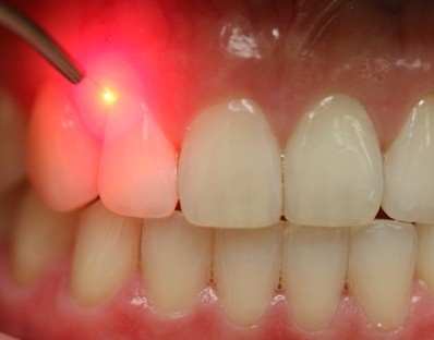 laserdentistry